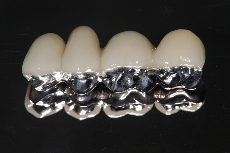 メタルボンドクラウン(メタルセラミッククラウン)