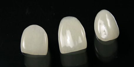 ポーセレンラミネートべニア