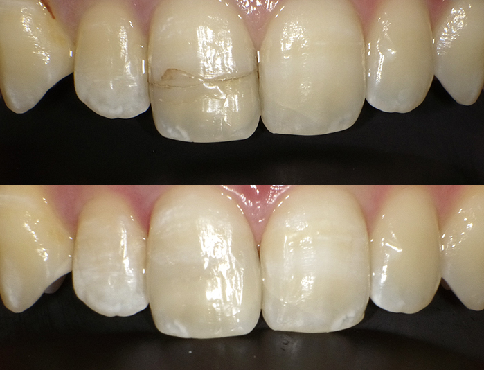 ダイレクトボンディング